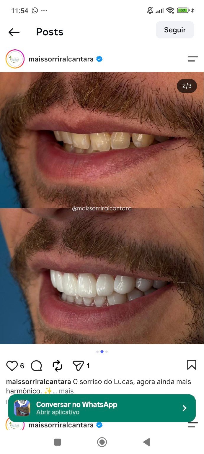 Caso clínico de transformação do sorriso compartilhado pela Mais Sorrir