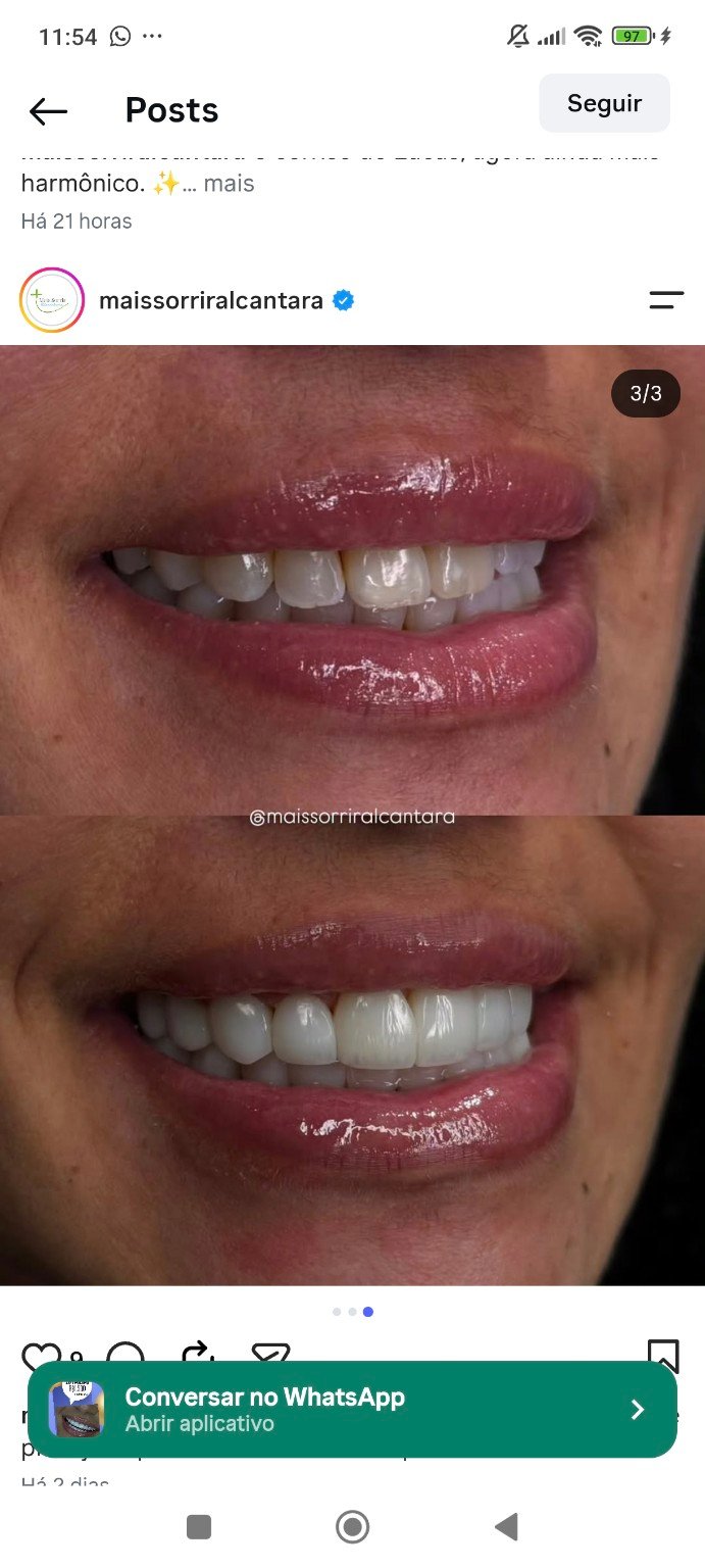 Evolução estética de sorriso compartilhada pela Mais Sorrir