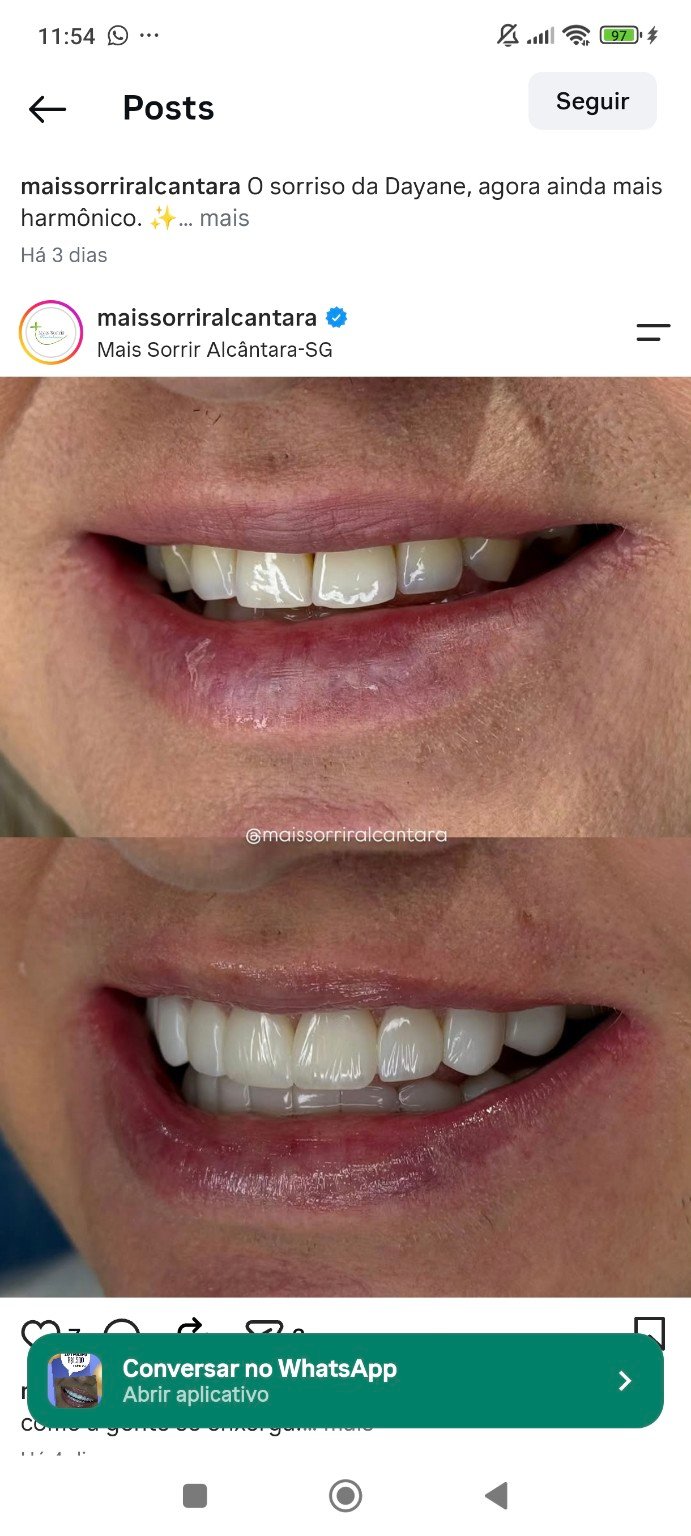 Caso de reabilitação estética compartilhado pela Mais Sorrir