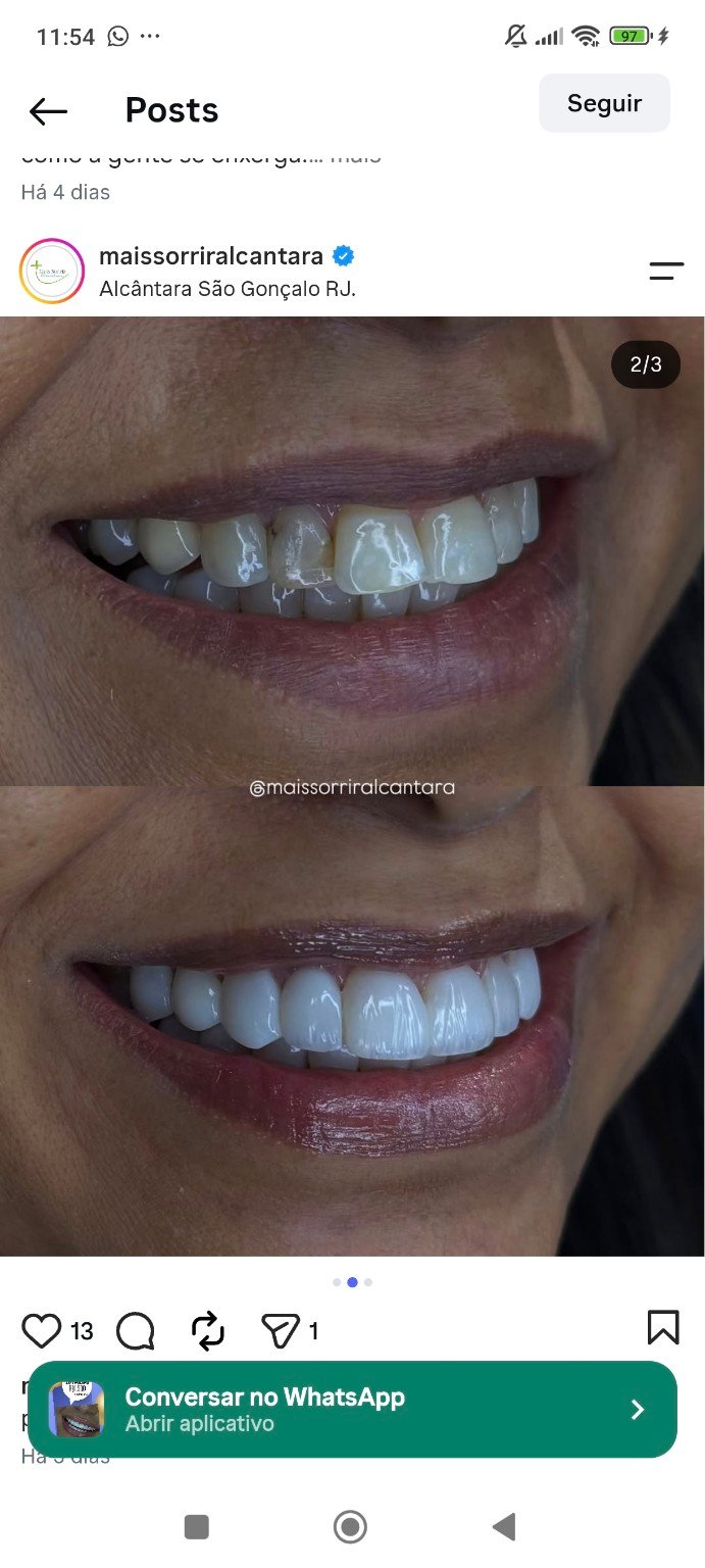 Resultado de tratamento odontológico compartilhado pela Mais Sorrir