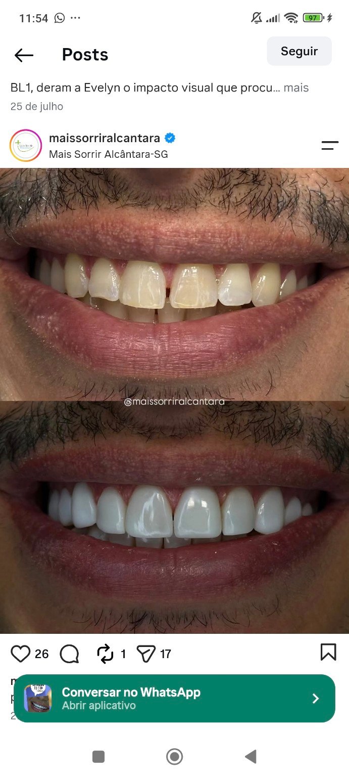Resultado de facetas compartilhado pela Mais Sorrir
